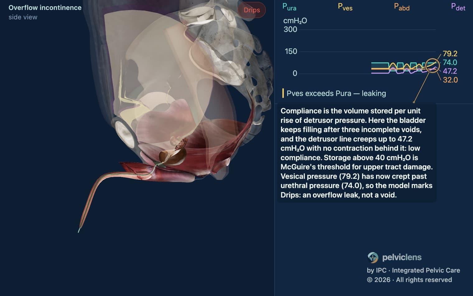 Cistometria e complacência no modelo de incontinência do Pelvic Lens: Pdet acima de 40 cmH2O na bexiga hiperdistendida