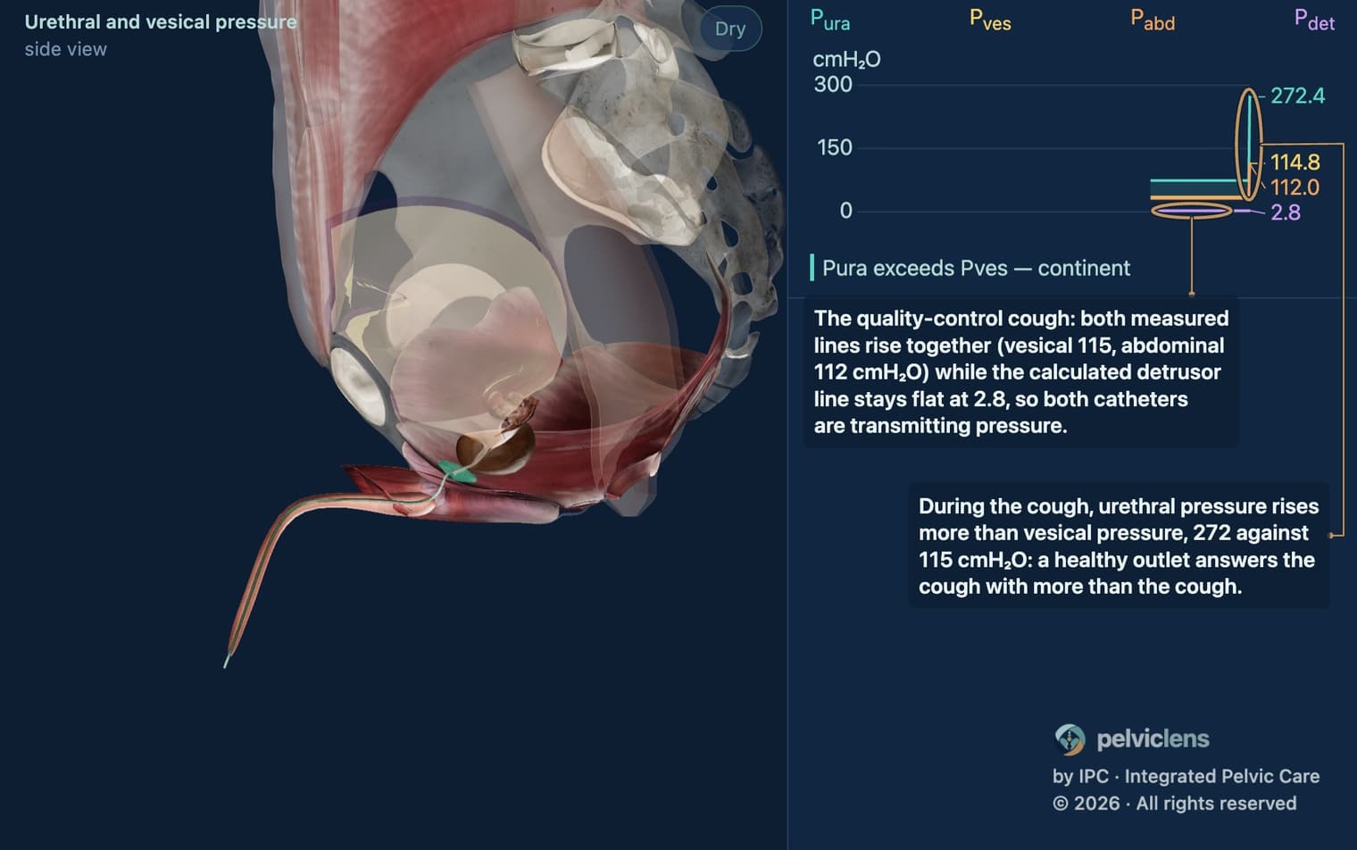 Cistometria com teste da tosse no modelo de incontinência do Pelvic Lens: pressão vesical contra pressão uretral na tosse