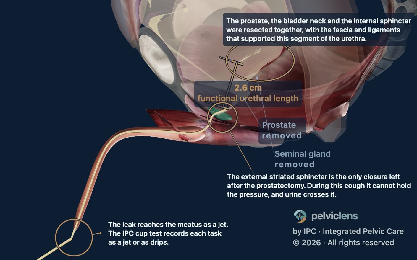 Intrinsic sphincter deficiency on the Pelvic Lens model: prostate resected, urethra 2.6 cm, the cough crossing the sphincter